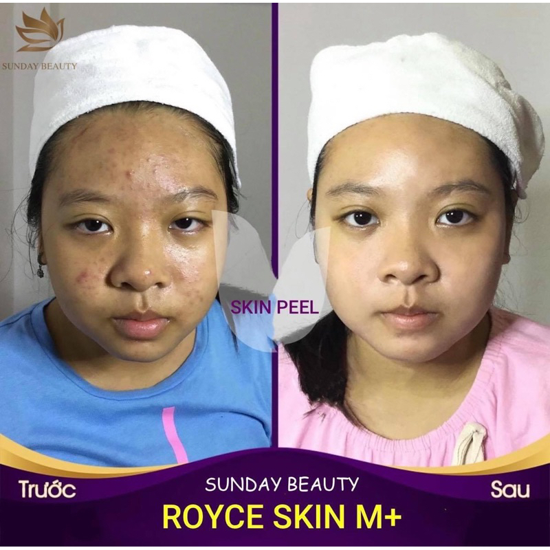 Peel da ROYCE SKIN M+ Peel da tái sinh diện mạo thời thanh xuân