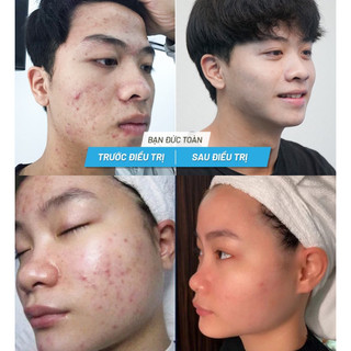 SERUM MỤN NGỌC SÂM [Mini] ✔️