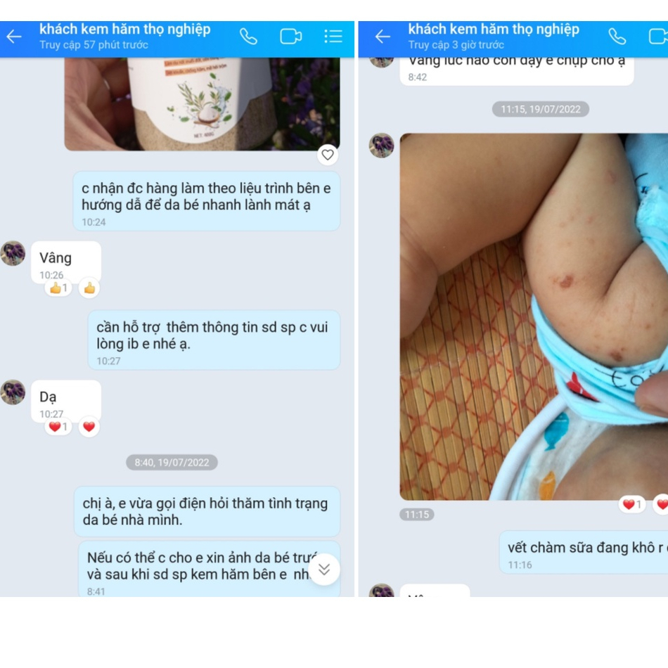 Kem Chống Hăm Em Bé Bon Bon  An Toàn Cho Bé - Giảm Ngay Hăm Ngứa , Rôm Sảy Trên Da Bé