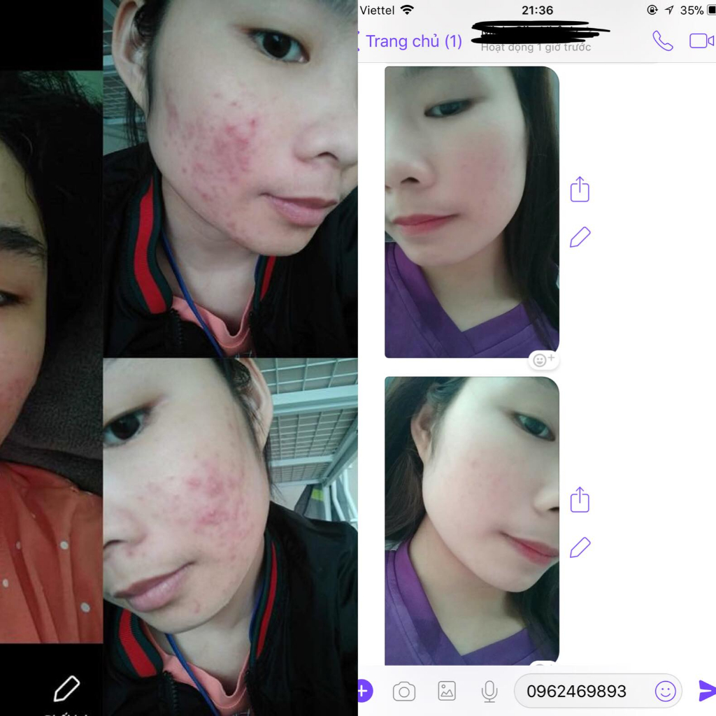 Serum loại bỏ mụn thâm tái tạo da peel acnes H tặng tinh chất nước thần Detoxblanc