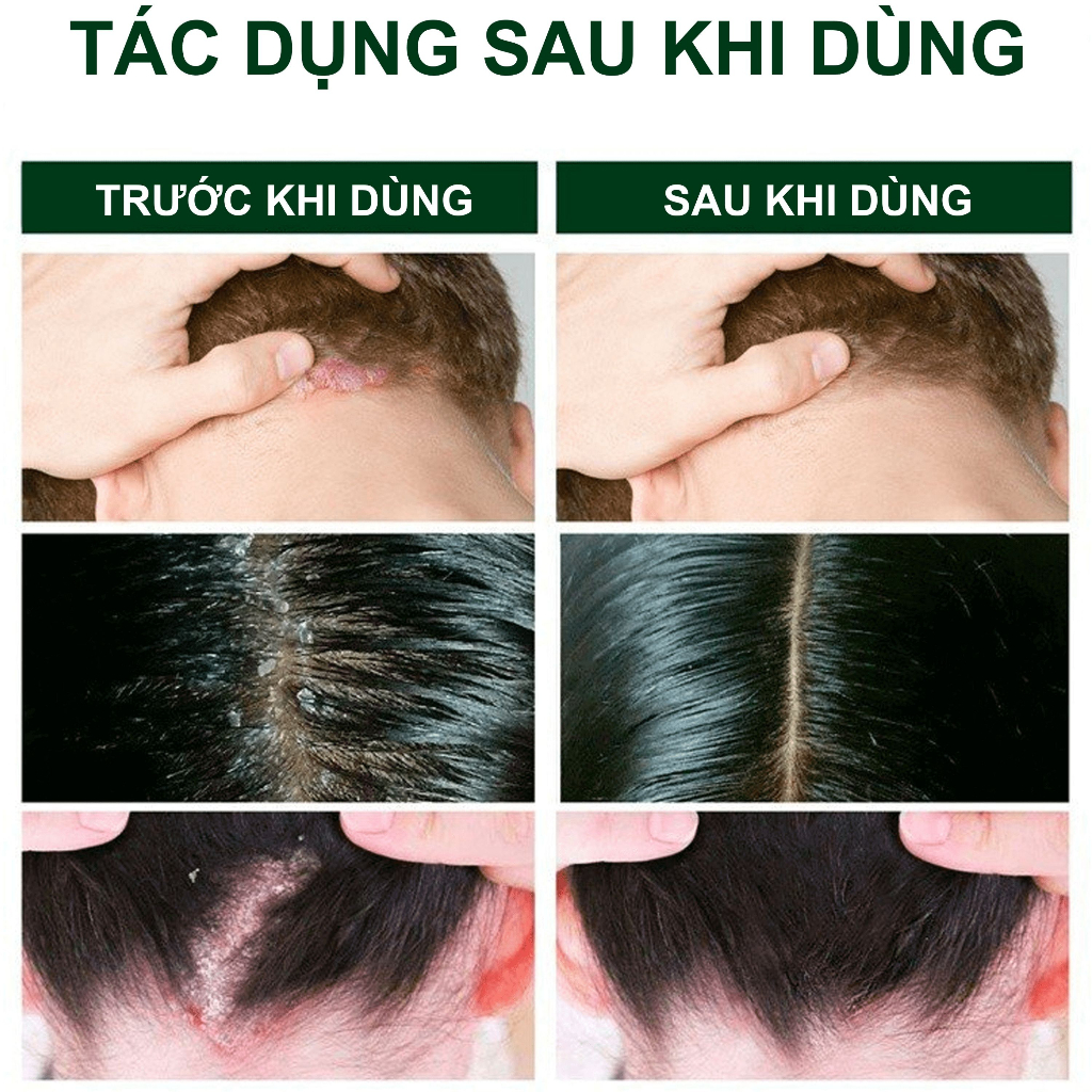 Dầu Gội Sạch Gàu Chiết Xuất Dược Liệu Antisol Hiệu Quả Nhanh, An Toàn Tuyệt Đối