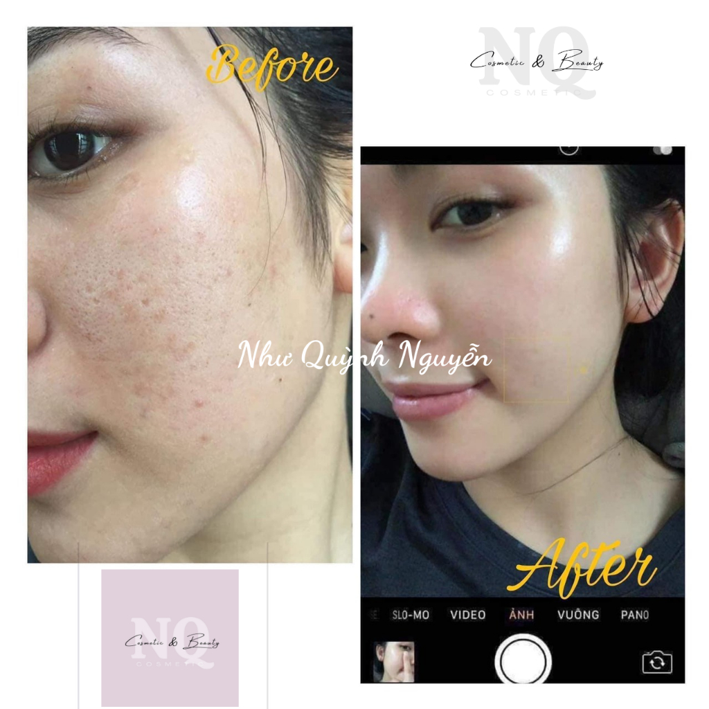 Kem Nám Melasma Treatment Cream Viian Làm Trắng Da, Đều Màu