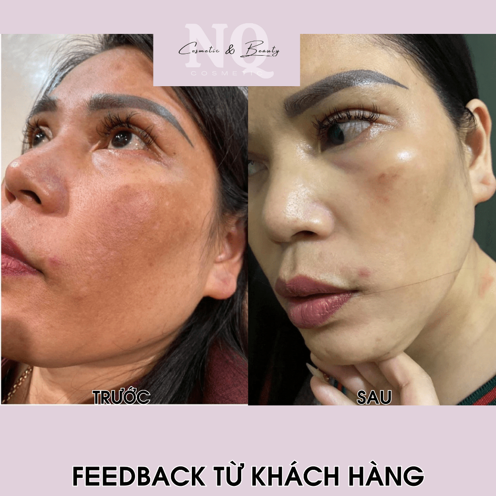 Kem Nám Melasma Treatment Cream Viian Làm Trắng Da, Đều Màu