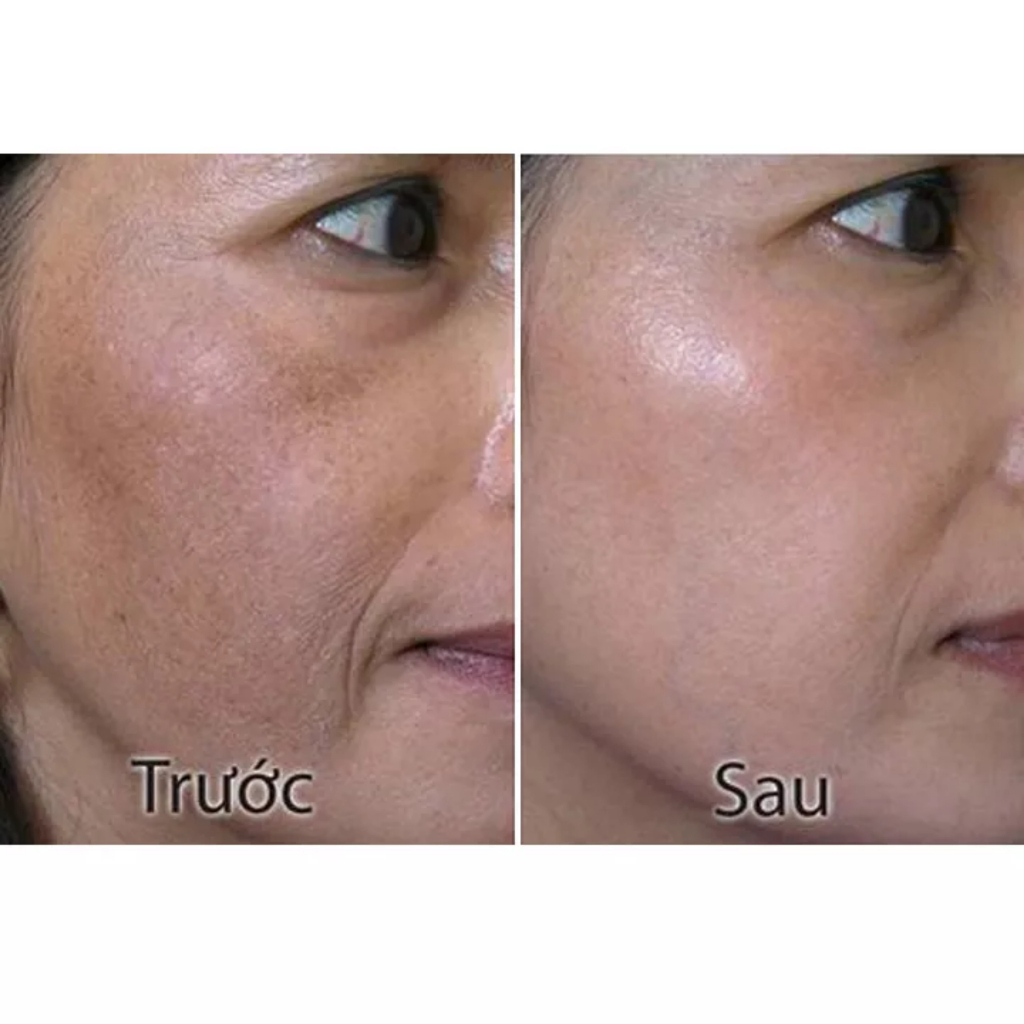 Bộ nám cao cấp Clobetamil G Thái Lan HÀNG LOẠI I