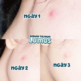 Serum mụn Lumos Acne (mẫu mới)