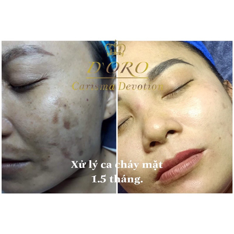 Kem Nám Sáng Da DORO 30g – Làm Sáng, Đều Màu Da, Ngừa Nám Sạm