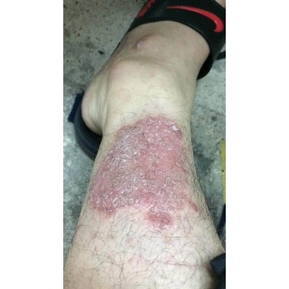 Kem bôi  nấm ngứa hắc lào á sừng vẩy nến