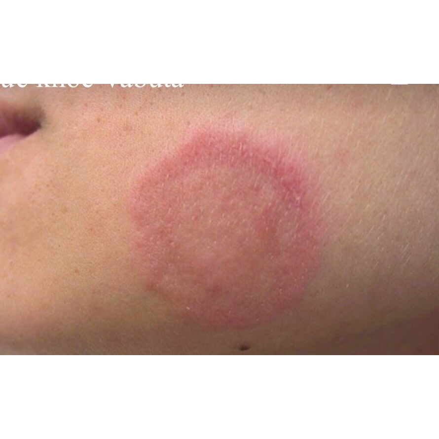 Kem bôi  nấm ngứa hắc lào á sừng vẩy nến