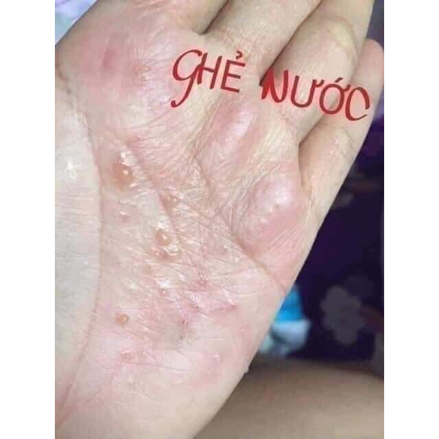 Kem bôi  nấm ngứa hắc lào á sừng vẩy nến