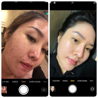 Kem Mụn Thảo Dược Hanaskincare
