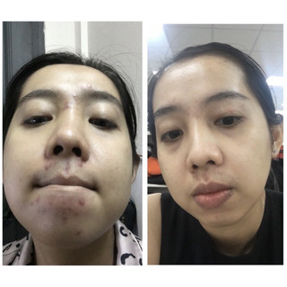 Kem Mụn Thảo Dược Hanaskincare