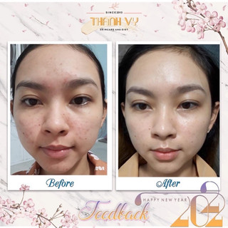 Kem Mụn Thảo Dược Hanaskincare