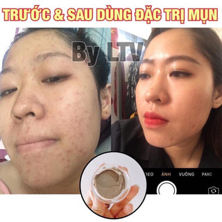 Kem Mụn Thảo Dược Hanaskincare