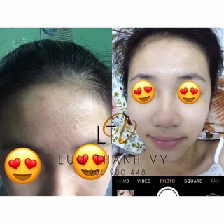 Kem Mụn Thảo Dược Hanaskincare