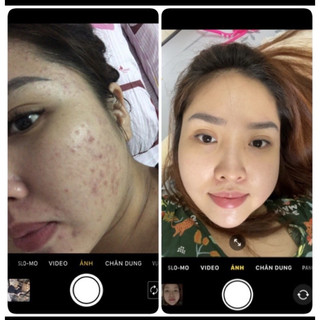 Kem Mụn Thảo Dược Hanaskincare