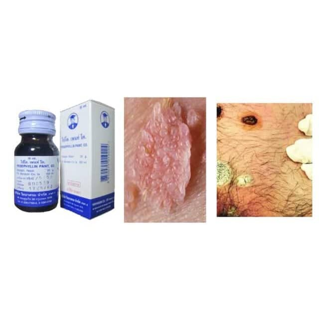 Dung Dịch Podophyllin 25% Thái Lan 15ml Đánh Bay Sùi Mào Gà Nhanh Chóng An Toàn