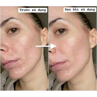 KEM ỨC CHẾ NÁM CAO CẤP SPA