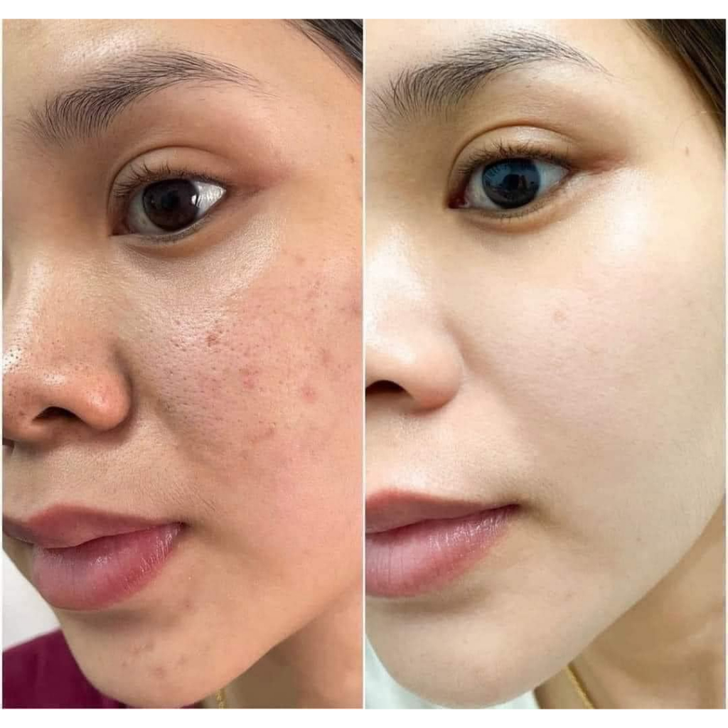 Hoạt chất peel da thu nhỏ lỗ chân lông,sẹo lõm, căng bóng trắng da TC.AGE Innoaesthetics