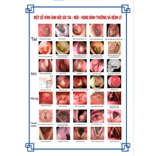 Tranh treo một số hình ảnh về nội soi tai mũi họng.Tranh treo nhựa cứng tráng gương cao cấp.