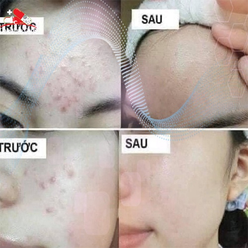 Gel Megaduo Plus giảm mụn thâm nám 15g AHA Retinal 15g dưỡng da mờ sẹo