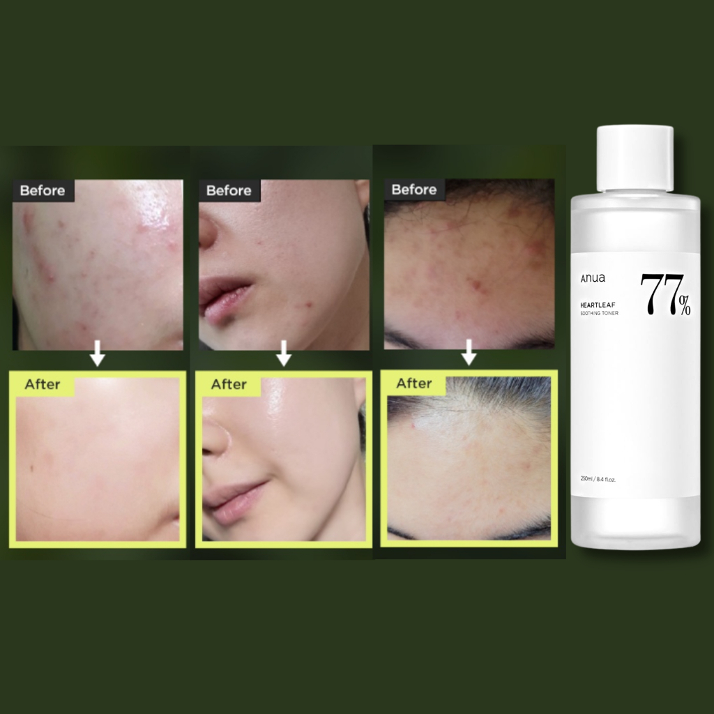 Toner làm dịu da ANUA chiết xuất diếp cá Heartleaf 77% Soothing Toner 250ml chính hãng