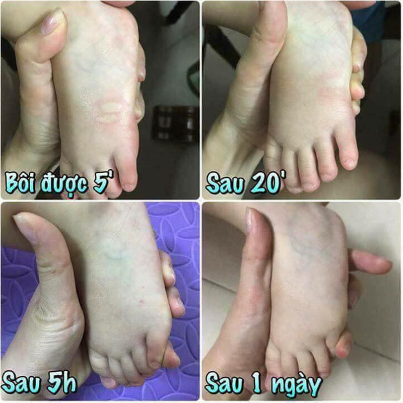 Kem, Cao Muỗi, Bôi Muỗi Đốt Mosquito Balm