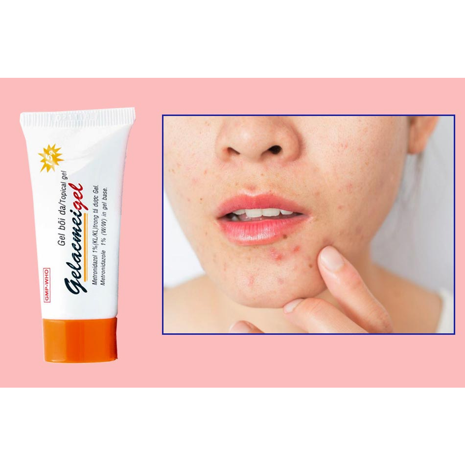 GEL BÔI DA GELACMEIGEL ACMEIGEL 15G BS BẢO HÂN