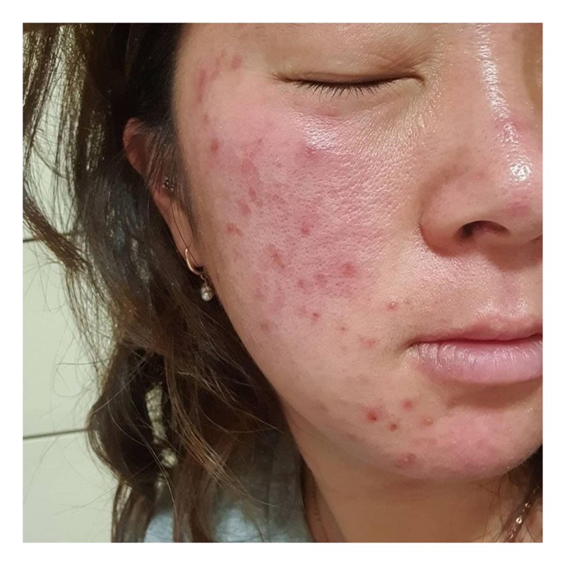 Rượu rễ cây mật gấu dạng vòi xịt chuyên mụn , thâm nám tàn nhang handmade