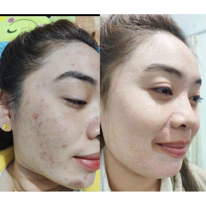 Rượu rễ cây mật gấu dạng vòi xịt chuyên mụn , thâm nám tàn nhang handmade