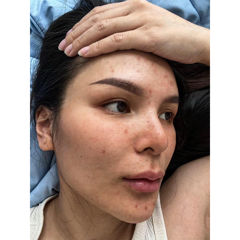 Rượu rễ cây mật gấu dạng vòi xịt chuyên mụn , thâm nám tàn nhang handmade