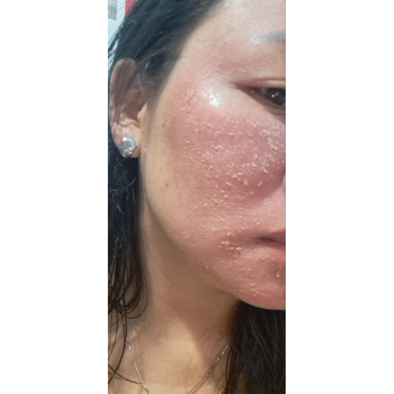 Rượu rễ cây mật gấu dạng vòi xịt chuyên mụn , thâm nám tàn nhang handmade