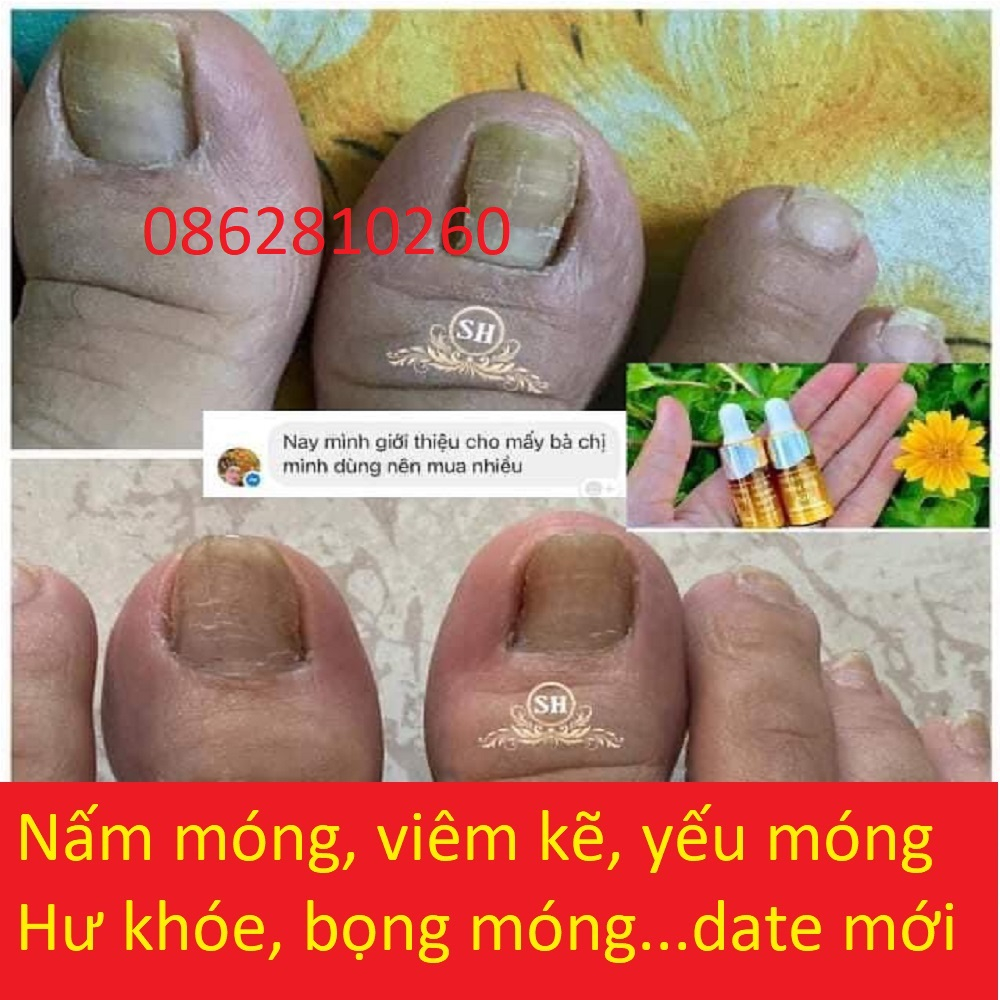 Serum Nấm Móng Tay Chân Sh, Hết Sạch nấm móng, Bọng Móng, Hư Khoé, Nước Ăn Tay Chân, Dưỡng Cứng Móng