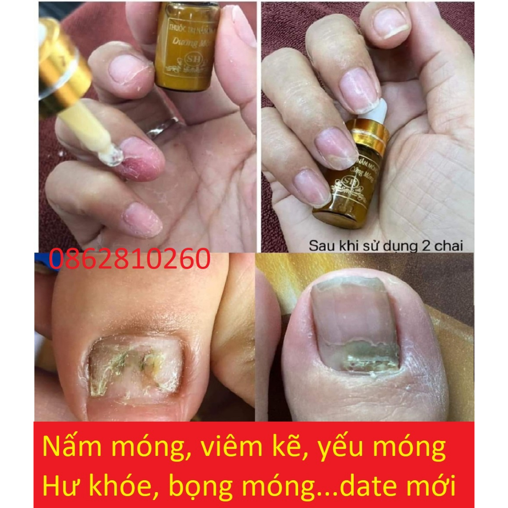 Serum Nấm Móng Tay Chân Sh, Hết Sạch nấm móng, Bọng Móng, Hư Khoé, Nước Ăn Tay Chân, Dưỡng Cứng Móng