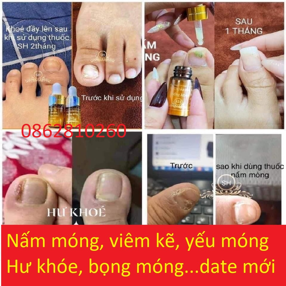 Serum Nấm Móng Tay Chân Sh, Hết Sạch nấm móng, Bọng Móng, Hư Khoé, Nước Ăn Tay Chân, Dưỡng Cứng Móng