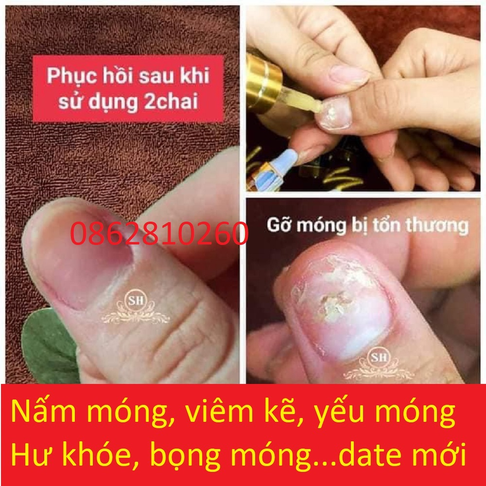Serum Nấm Móng Tay Chân Sh, Hết Sạch nấm móng, Bọng Móng, Hư Khoé, Nước Ăn Tay Chân, Dưỡng Cứng Móng