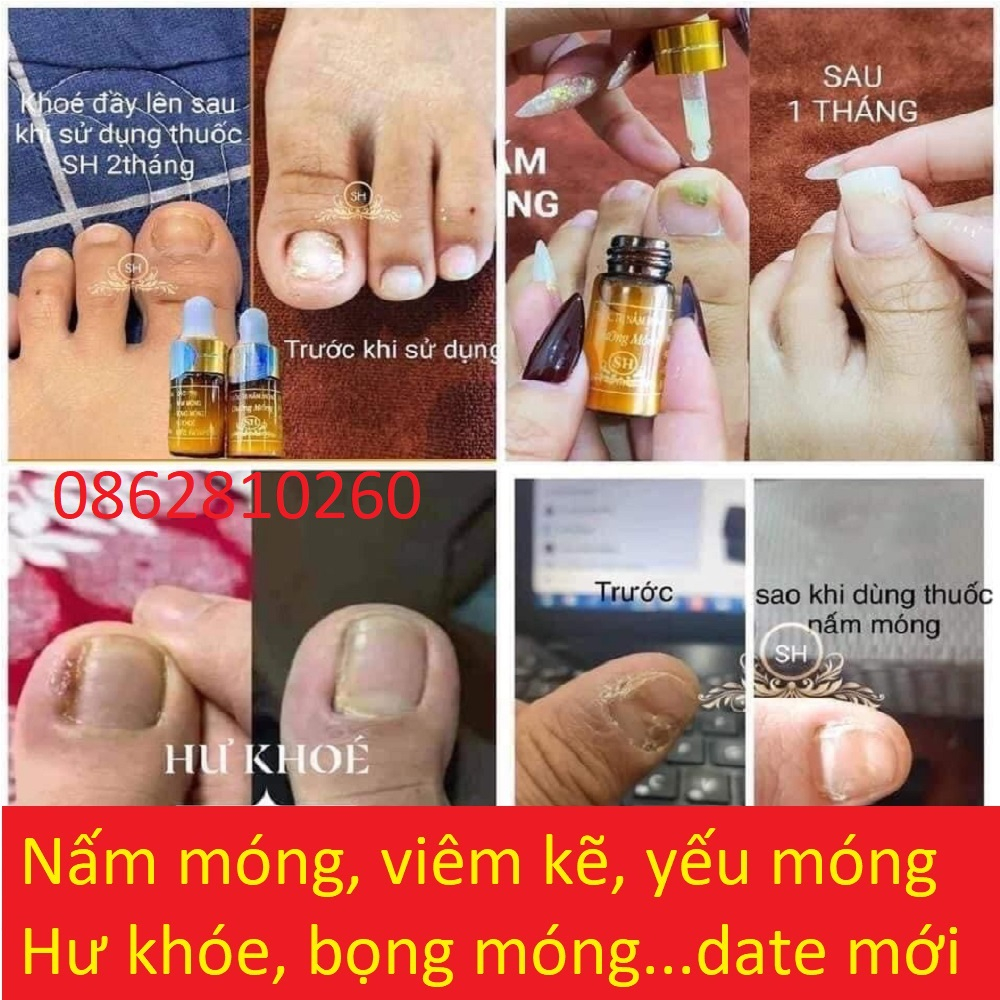 Serum Nấm Móng Tay Chân Sh, Hết Sạch nấm móng, Bọng Móng, Hư Khoé, Nước Ăn Tay Chân, Dưỡng Cứng Móng