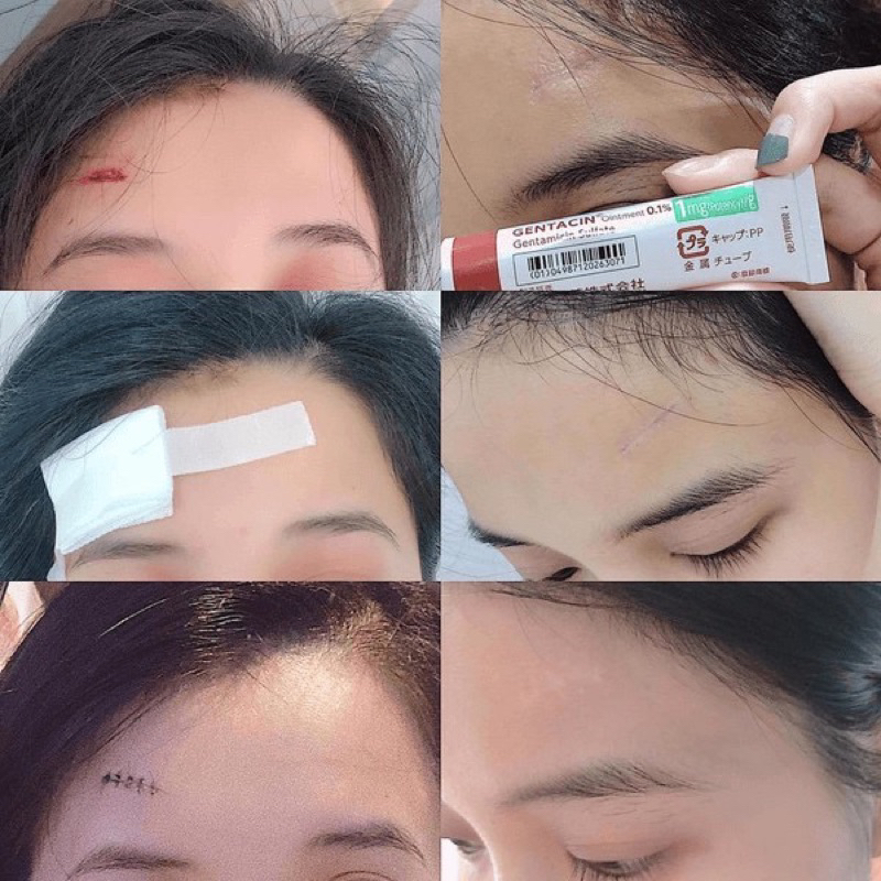 Gel bôi làm mờ vết sẹo, mịn da 10g