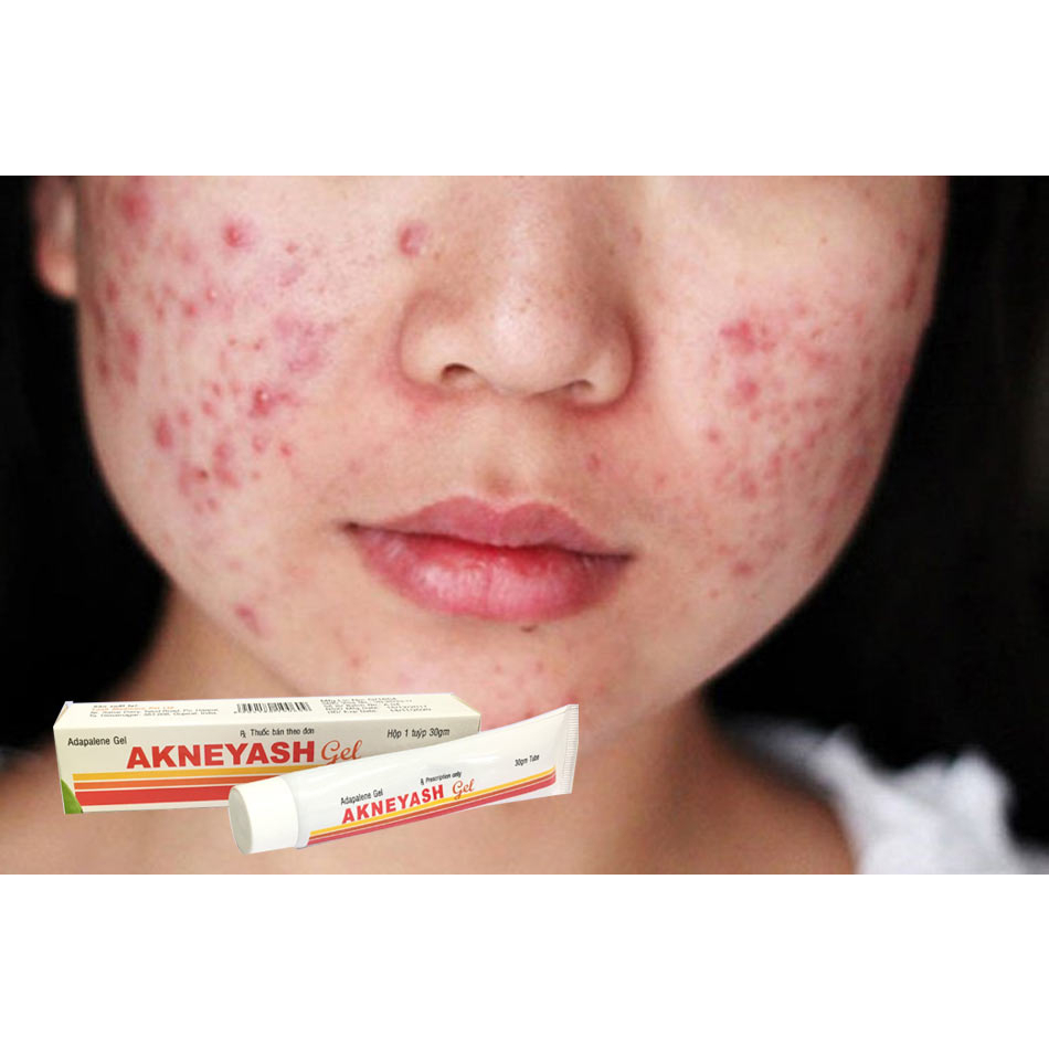 Mụn thâm, mụn ẩn - Gel Akneyash bôi ngoài da dành cho da mụn ẩn thâm mụn sần sùi - bs Yến