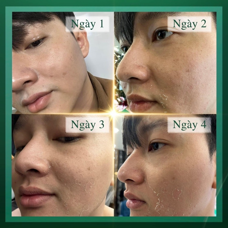 Kem tái tạo nội mô MQ SKIN  Exfollant Cream 30g