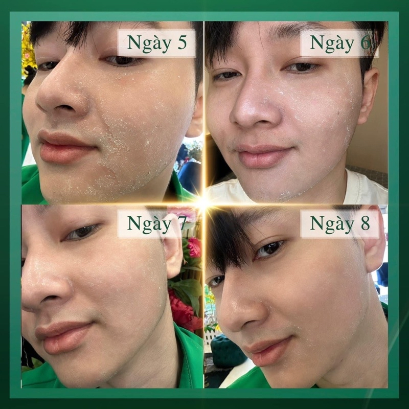 Kem tái tạo nội mô MQ SKIN  Exfollant Cream 30g