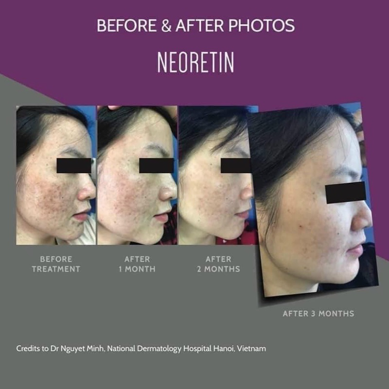 Serum Neoretin cho da nám 15ml