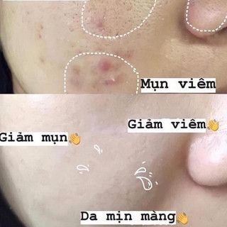 The Ordinary AHA 30% + BHA 2% Peeling phân loại 30ml