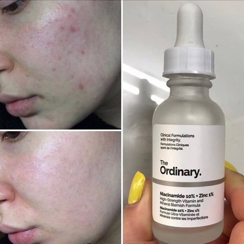 Serum Tinh Chất Ngừa Mụn, Sáng Da Niacinamide 10% + Zinc 1% - The Ordinary Hyaluronic