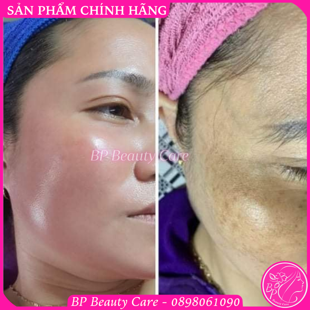 Serum LUVERIO số 2 Melasma Pigment xóa nám thủy kim chuyên sâu, xóa thâm da lâu ngày