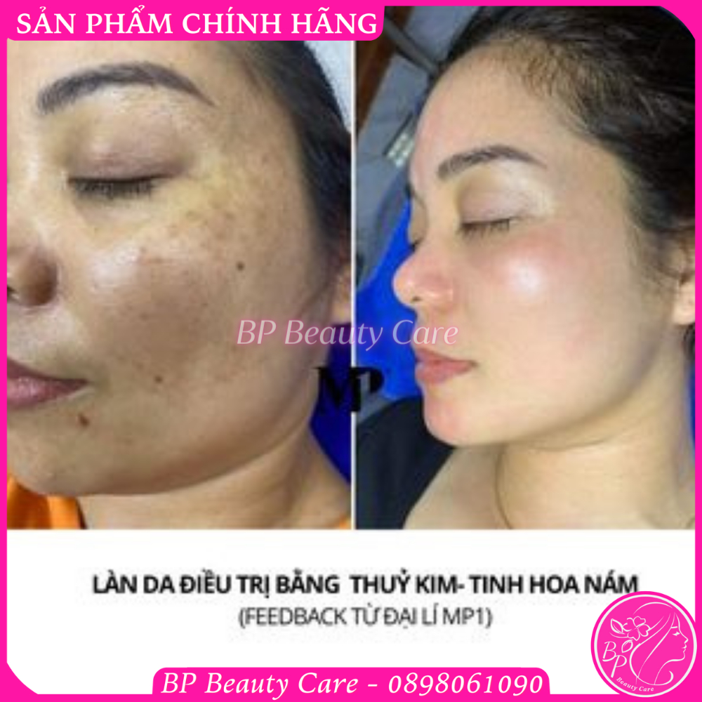 Serum LUVERIO số 2 Melasma Pigment xóa nám thủy kim chuyên sâu, xóa thâm da lâu ngày