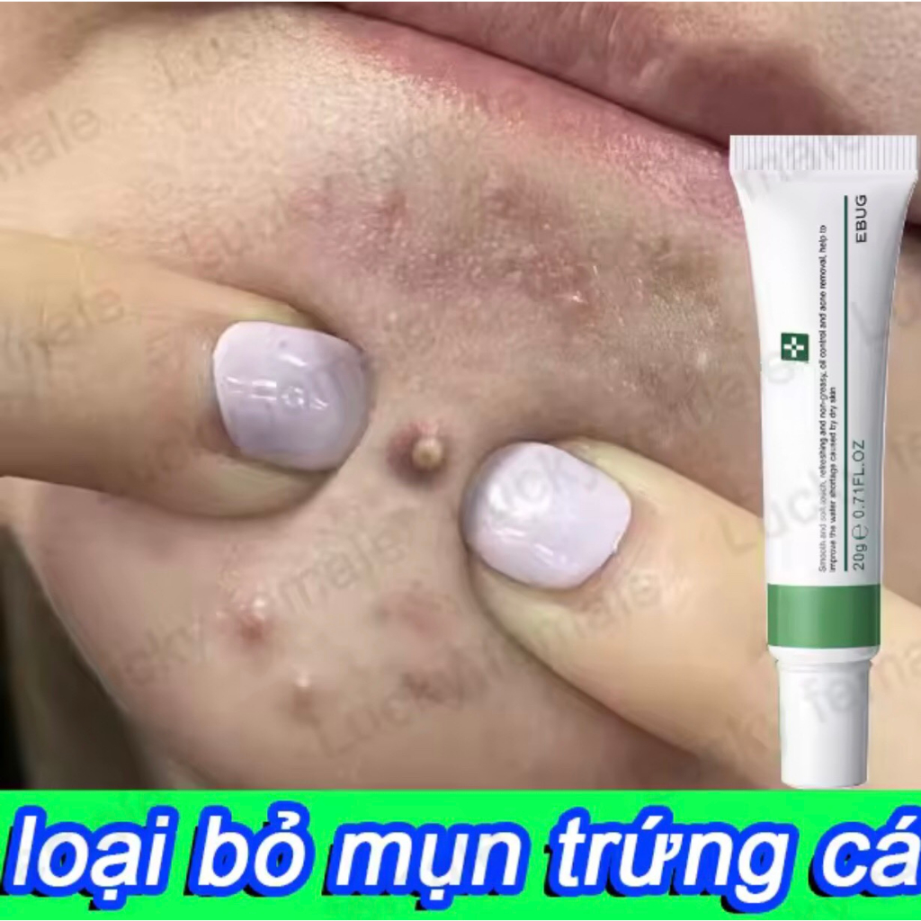 Kem mụn 20 g Giảm Thâm Mụn thâm mụn mặt nạ giảm mụn tàn nhang làm trắng dưỡng ẩm sửa chữa mụn