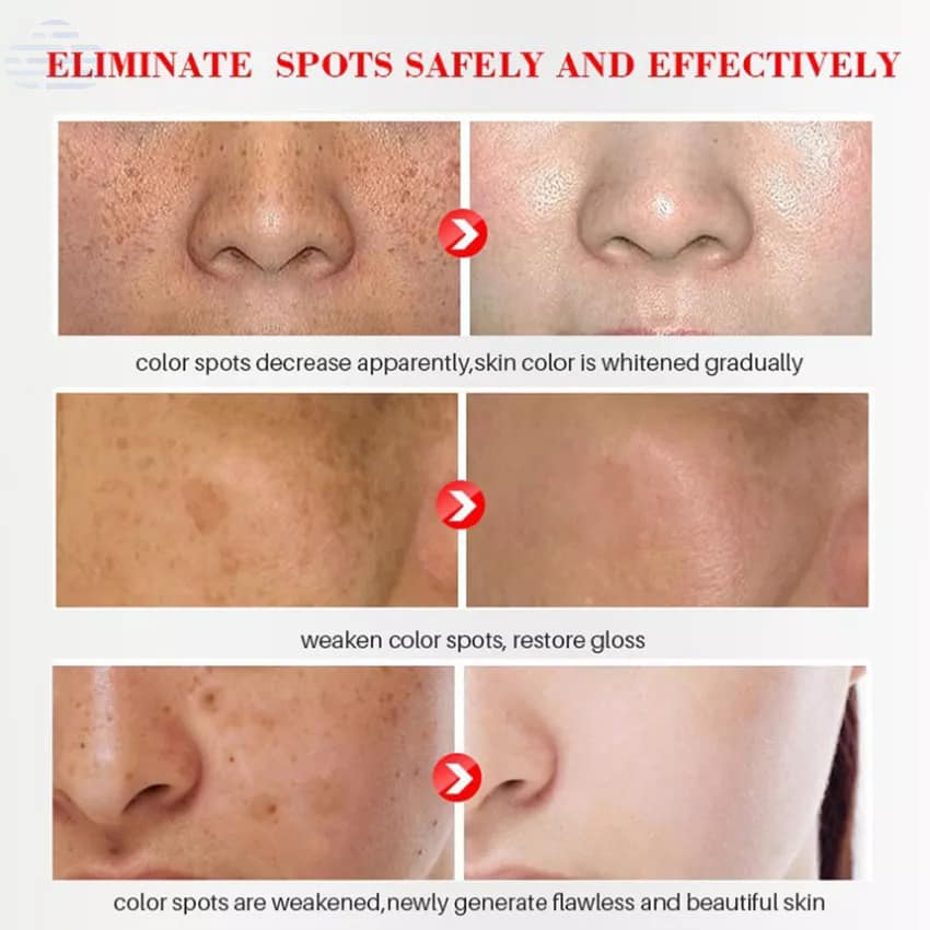 💓ROSANCE X18 GEL TRẮNG DA, XÓA MỜ ĐỐM NÂU, SẸO THÂM - PHÁP 550k sale 80k💓