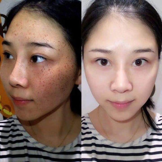 KEM  Nám Thái Lan 3 công dụng