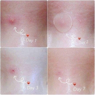 Dán mụn Careplus Oliveyoung