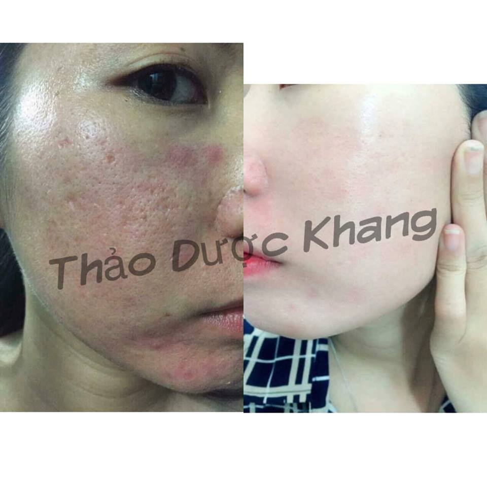Combo ngừa mụn, thâm nám, cấp ẩm cho da, Serum Luxury Thảo Dược Khang & bột thảo dược ủ trắng và phục hồi da - TDK SKIN